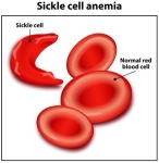 http://pedsgh.com/sickle-cell-disease-in-children-part-one/